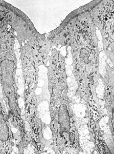 jejunum … lipid malabsorption jejunum … lipid malabsorption